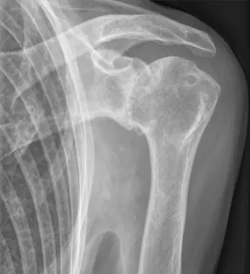 Radiograph from the case bank: Osteoarthritis