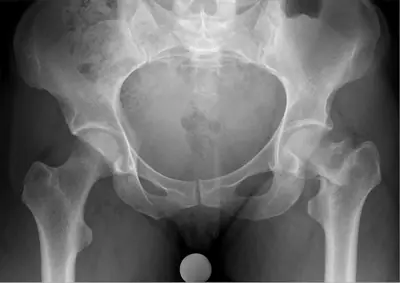 Radiograph from the case bank: Hip (proximal femoral) fracture