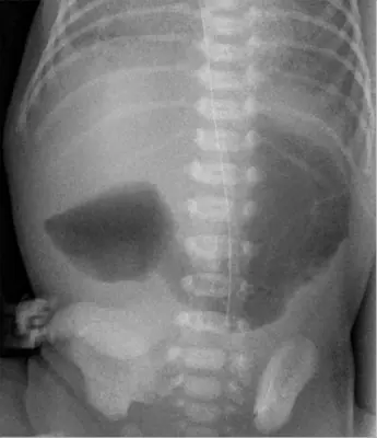 Radiograph from the case bank: Double bubble sign (duodenal atresia)