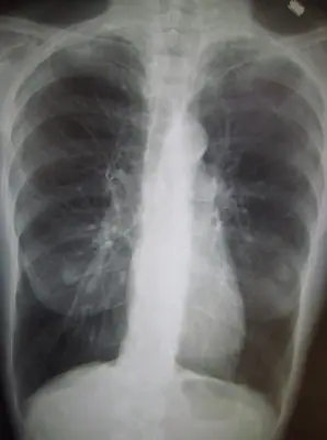 Radiograph from the case bank: Emphysema / COPD (hyperinflation)