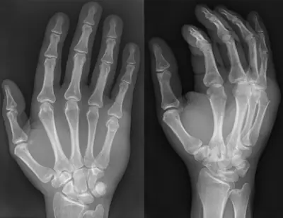Radiograph from the case bank: Metacarpal fracture