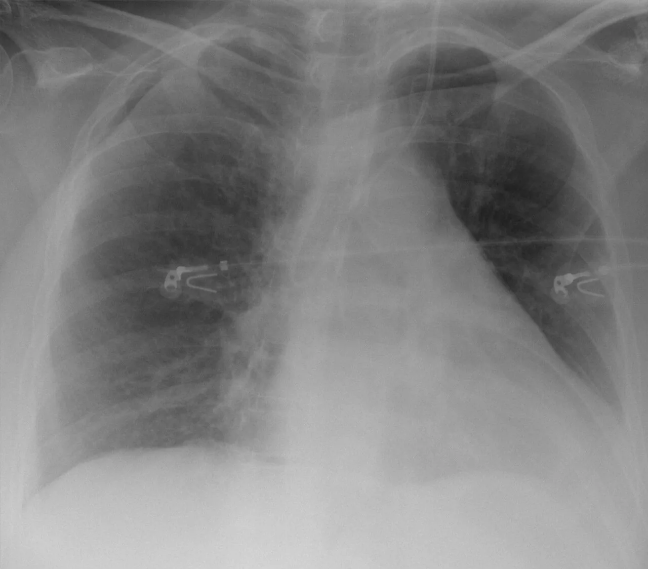 Lines & tubes radiograph for self-assessment