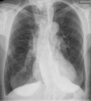 Radiograph from the case bank: Emphysema / COPD (hyperinflation)