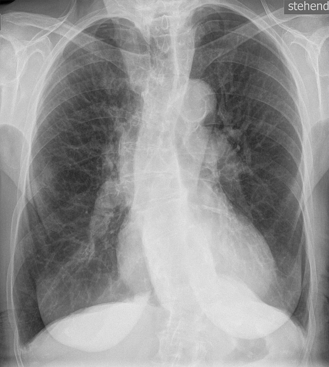 Chest radiograph for self-assessment