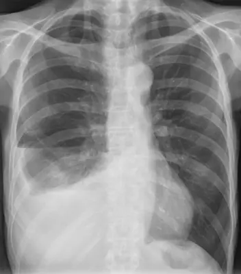 Radiograph from the case bank: Pneumothorax