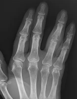 Radiograph from the case bank: Gout