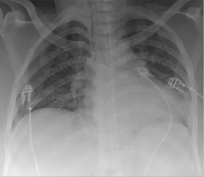 Radiograph from the case bank: Pericardial effusion