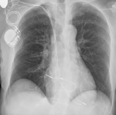 Radiograph from the case bank: Cardiac pacemaker