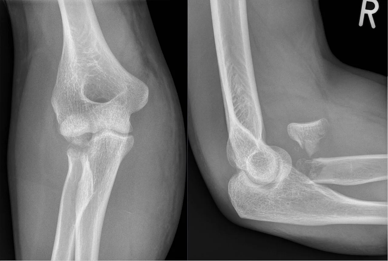 Upper limb radiograph for self-assessment