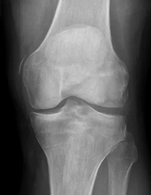 Radiograph from the case bank: Pellegrini–Stieda lesion