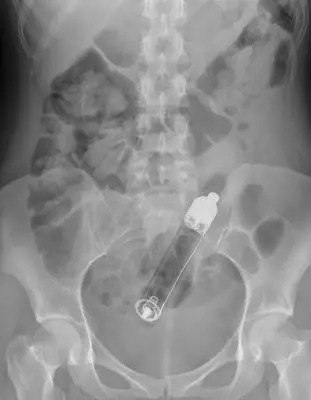 Radiograph from the case bank: Foreign body (ingested or inserted)