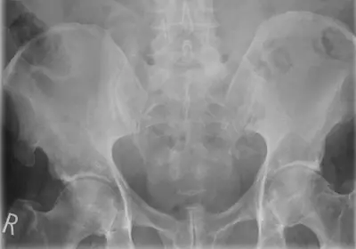 Radiograph from the case bank: Osteochondroma (exostosis)
