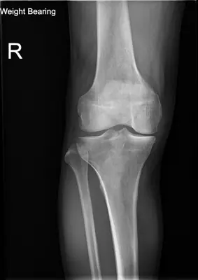 Radiograph from the case bank: Knee osteoarthritis