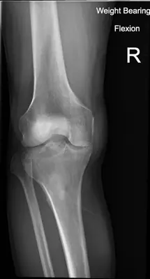 Radiograph from the case bank: Knee osteoarthritis
