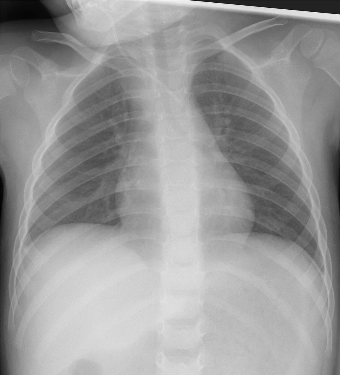 Lines & tubes radiograph for self-assessment