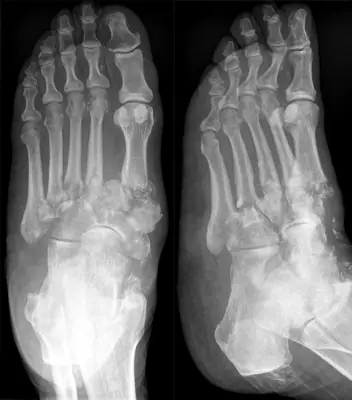 Radiograph from the case bank: Neuropathic (Charcot) arthropathy