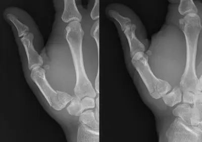 Radiograph from the case bank: Rolando fracture