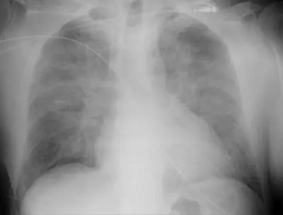 Radiograph from the case bank: Pulmonary oedema (heart failure)