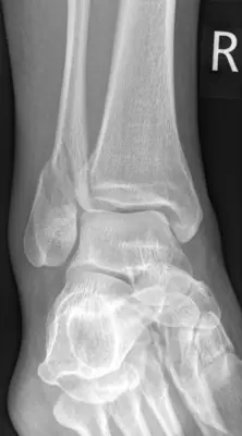 Radiograph from the case bank: Ankle fracture (lateral malleolus)