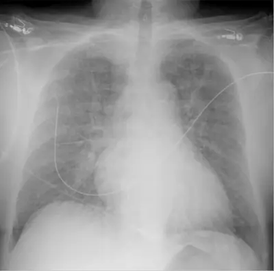Radiograph from the case bank: Pulmonary oedema (heart failure)