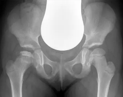 Radiograph from the case bank: Perthes disease