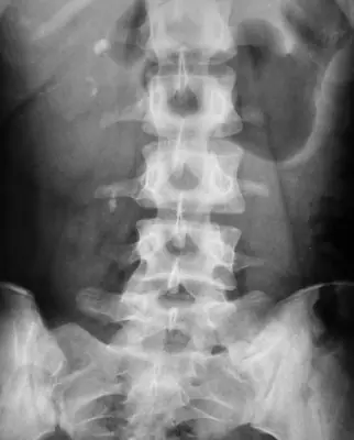 Radiograph from the case bank: Urinary tract calculi (kidney or ureteric stones)