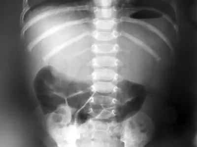 Radiograph from the case bank: Bowel obstruction