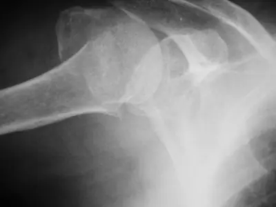 Radiograph from the case bank: Proximal humerus fracture
