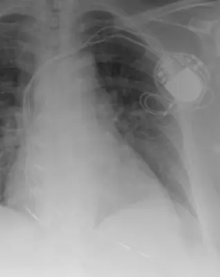Radiograph from the case bank: Cardiac pacemaker
