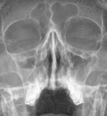 Radiograph from the case bank: Maxillary sinusitis