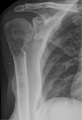 Radiograph from the case bank: Bone metastases