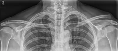 Radiograph from the case bank: Acromioclavicular joint dislocation