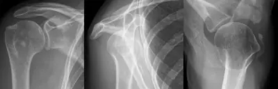 Radiograph from the case bank: Calcific tendinitis