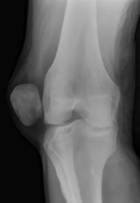 Radiograph from the case bank: Patellar dislocation