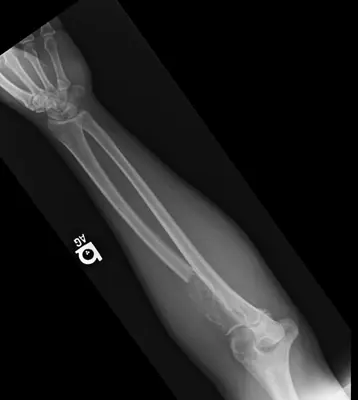 Radiograph from the case bank: Multiple myeloma