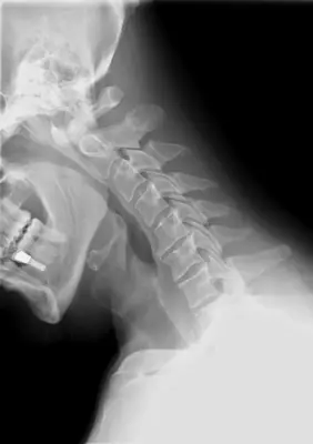 Radiograph from the case bank: Degenerative spondylosis