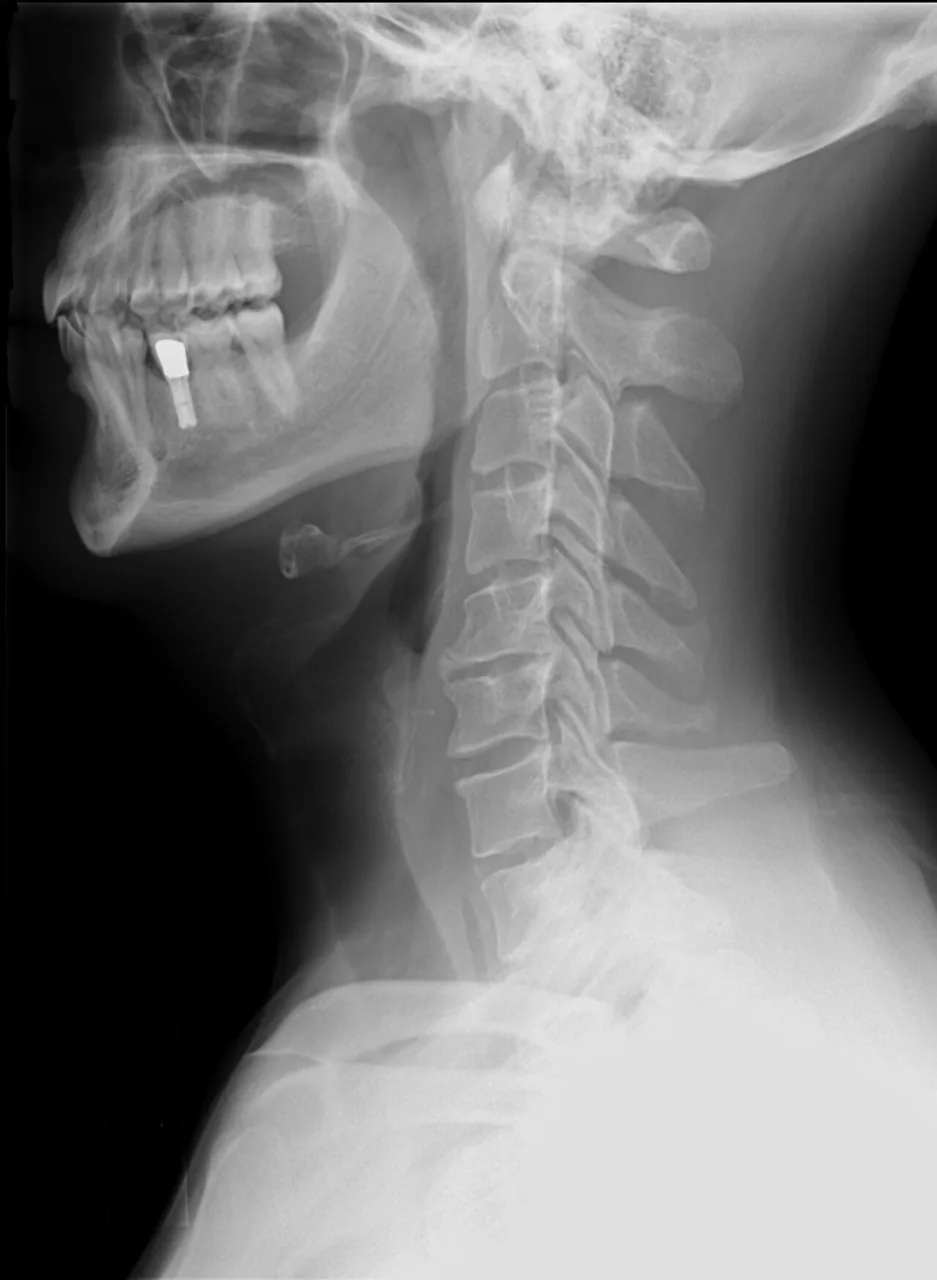 Spine radiograph for self-assessment