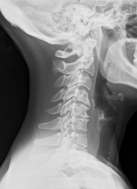 Spine radiograph for self-assessment