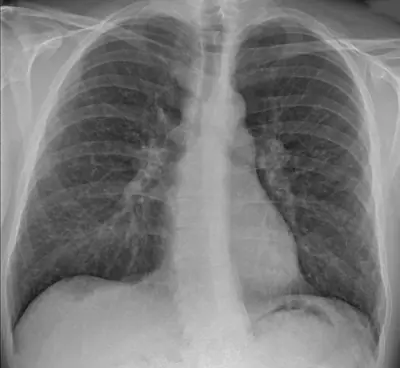 Radiograph from the case bank: Sarcoidosis