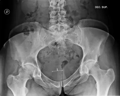Radiograph from the case bank: Intrauterine contraceptive device (IUCD)