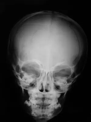 Radiograph from the case bank: Skull fracture