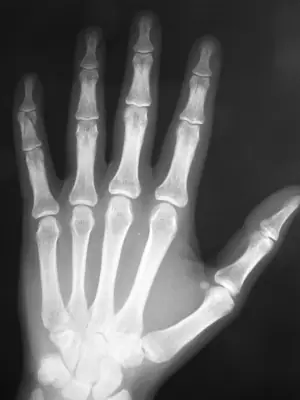 Radiograph from the case bank: Finger (phalangeal) fracture