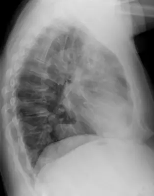 Radiograph from the case bank: Hiatus hernia