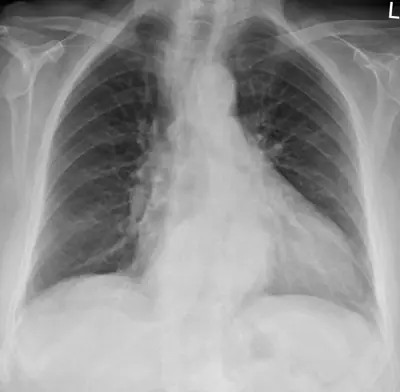 Radiograph from the case bank: Hiatus hernia
