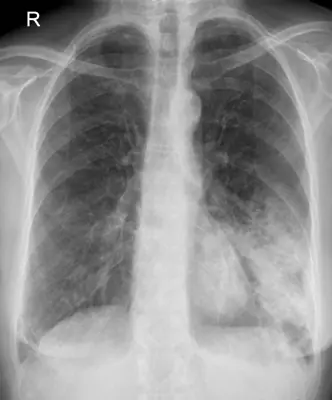 Radiograph from the case bank: Pneumonia (consolidation)