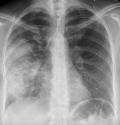 Radiograph from the case bank: Pneumonia (consolidation)