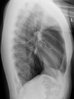 Radiograph from the case bank: Pneumothorax