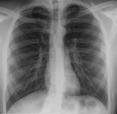 Radiograph from the case bank: Pneumothorax