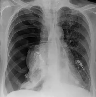 Radiograph from the case bank: Pneumothorax