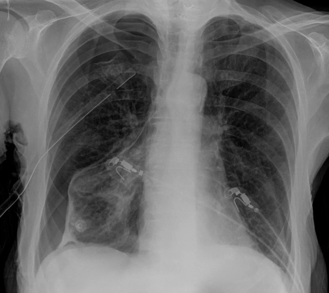 Chest radiograph for self-assessment